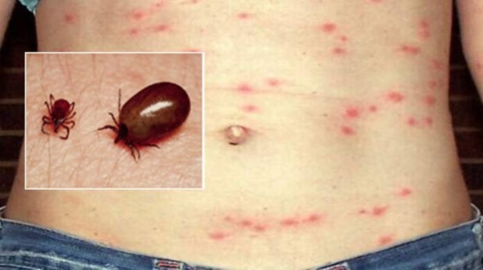 Scrub-Typhus health1692277065